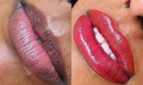 lip discoloration treatment before after mississauga oakville
